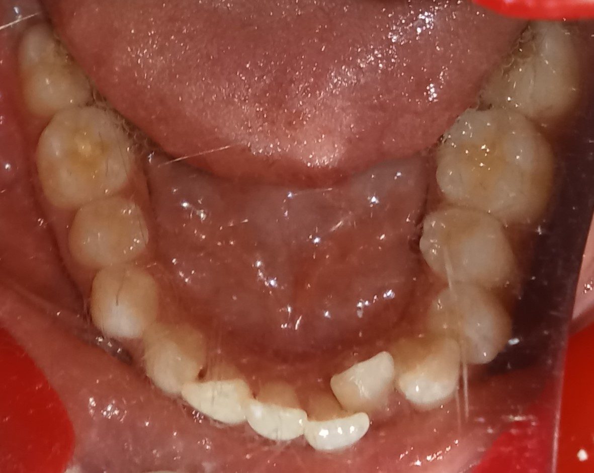Before — lower arch occlusal view