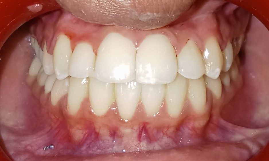 After — frontal view, teeth aligned, upper lip supported