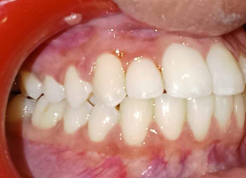 After — right lateral view