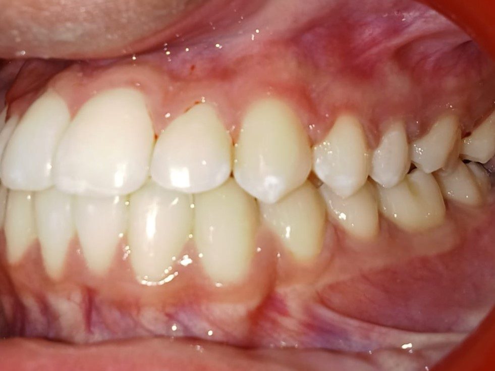 After — left lateral view