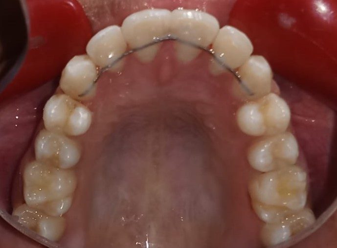 After — upper arch occlusal view, aligned with fixed retainer