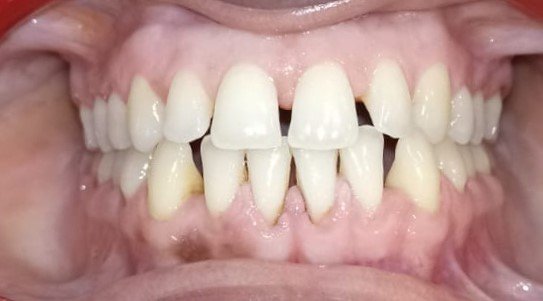 Before — frontal view showing generalised spacing and midline diastema