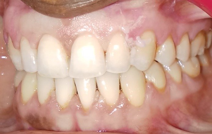 After — right lateral view